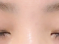 쌍꺼풀 재수술 후기