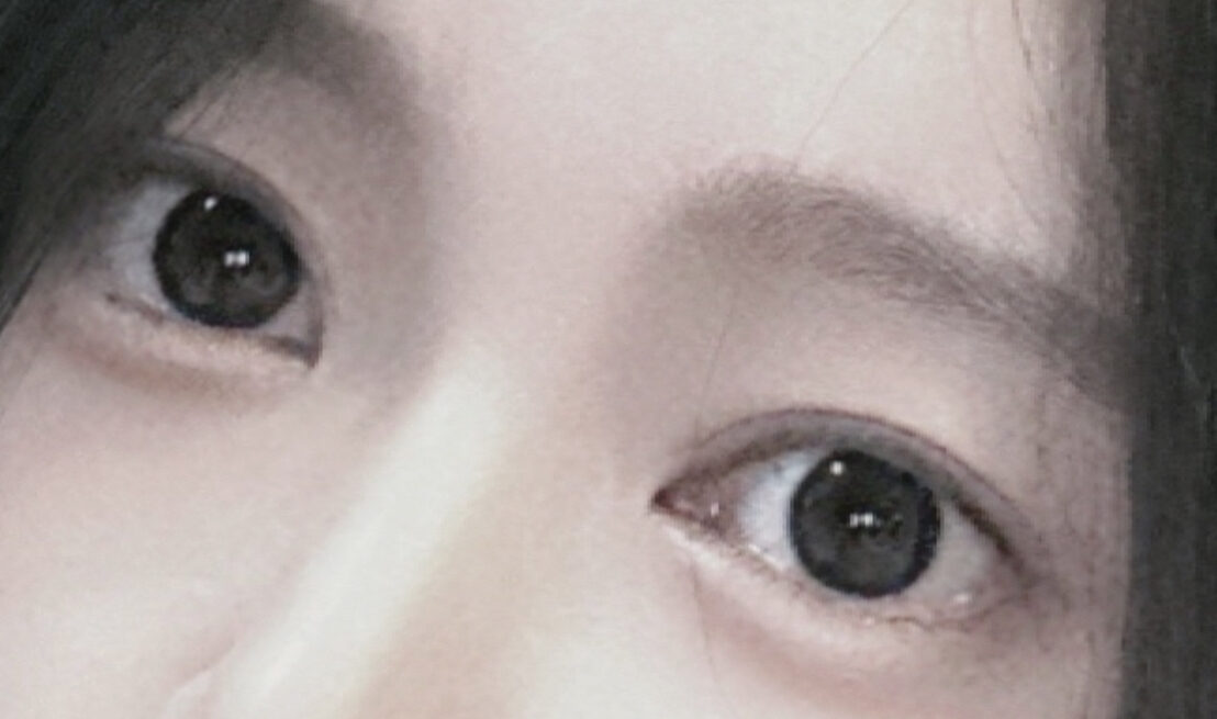 자연유착 윗트임 2달차 후기