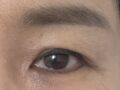 도언록 원장님 (중년 눈성형)