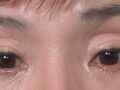 눈밑지방 재배치