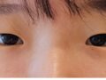 일미리 성형외과 쌍수 (도언록 원장님)