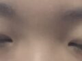 매몰 쌍커플, 윗트임