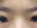 쌍꺼풀 재수술 (도언록 원장님)