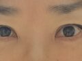 눈(쌍꺼풀, 하안검) 성형 2달 후