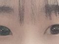 절개쌍커풀 후기!(도언록 원장님)