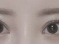 김홍진원장님 눈 재수술 한달차 후기