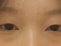 쌍커풀 수술 후기