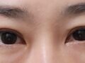 나영수 원장님 자연유착 쌍수 눈밑지방재배치