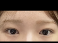 도언록 원장님 눈 재수술
