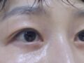 도언록원장님  눈성형  +지방이식 및 재배치