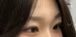 자연유착 윗트임 후기