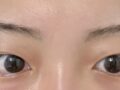 일미리 김홍진 원장님 쌍수후기