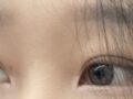 김홍진 원장님 자연유착 한달차 후기