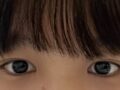 도언록 원장님 비절개 + 앞위트임 수술 후기