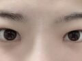 절개+앞트임 후기
