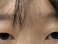 비절개 눈매교정 후기