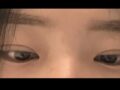 김홍진 원장님 비절개