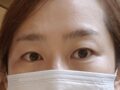 도언록원장님 눈성형 두달후기