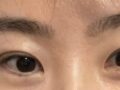도언록 원장님 재수술 후기입니다