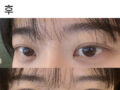 김홍진 원장님 쌍커풀 수술 후기