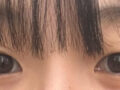 도언록 원장님 눈 자연유착+윗트임 후기