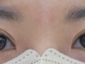 일미리 도언록 원장님 눈 재수술 후기(절개+윗트임+오른쪽 뒤밑트임)
