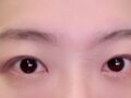 일미리 도언록 원장님께 부분절개 눈매교정 받은 후기입니당