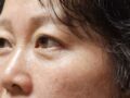 일미리 눈밑지방재배치