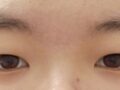 1mm 눈 절개쌍커풀 두달반차 후기