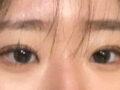 쌍수 3개월차 후기