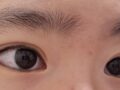 일미리 도언록원장님 쌍커풀+윗트임 수술 후기