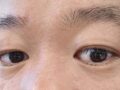 수술 2달차 후기
