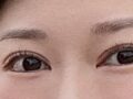 일미리 눈재수술 후기
