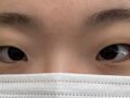 일미리 쌍수(절개+앞트임)