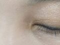 1mm 성형외과 안검하술, 썽커풀