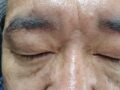 1mm 안검하술, 눈밑지방