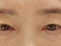 눈썹거상술 수술후기