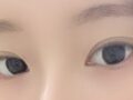 김홍진 원장님 자연유착 후기