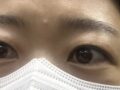 눈썹하거상술+자연유착 후기
