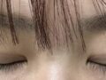 쌍꺼풀 절개 후기