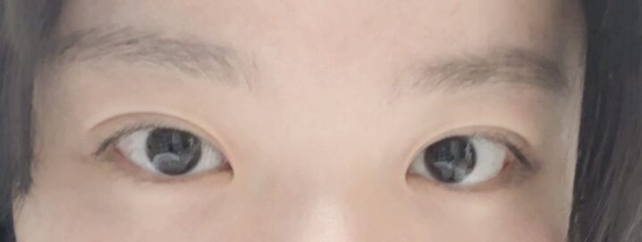 (김홍진 원장님) 자연유착 후기