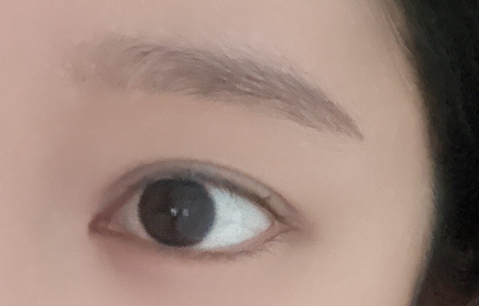첫수술 자연유착 윗트임 후기 !!!