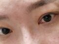 재수술 후기 김홍진 선생님