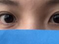 자연유착 매몰 쌍수 2달차 후기(김홍진 원장님)