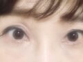 눈밑지방재배치후기
