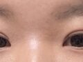 도원장님 수술후기