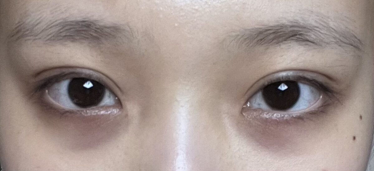 쌍수+눈밑지 후기