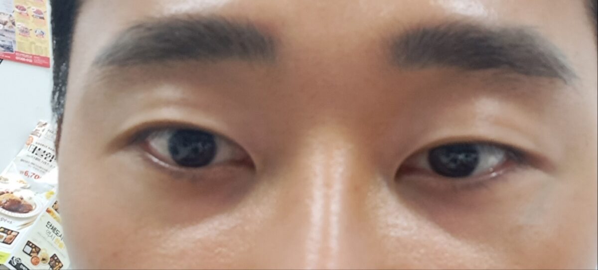 도언록 원장님  눈밑지방 재배치 후기