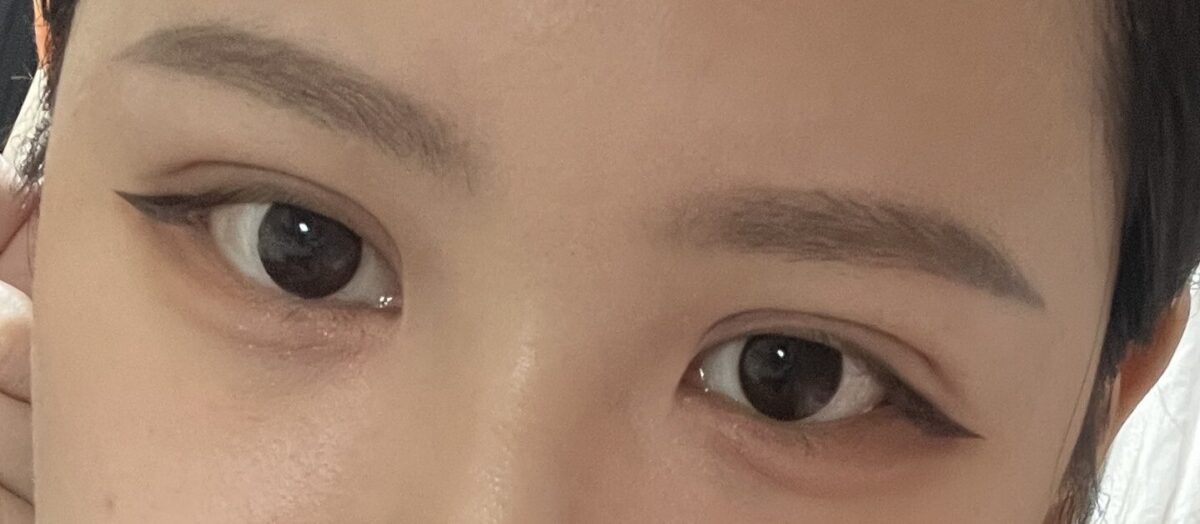 도언록대표원장님(비절개 쌍수후기)