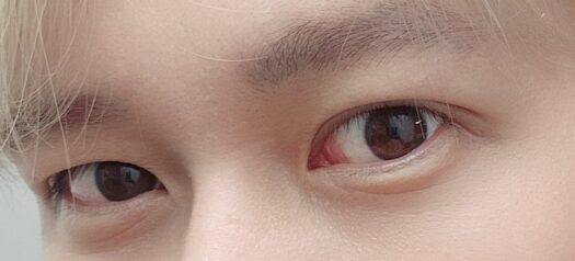 썽커풀 및 눈매교정